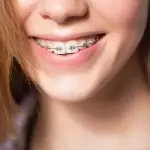 Niềng răng tuổi 30 – Đừng bỏ lỡ cơ hội đổi đời với nụ cười đẹp!