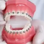 Niềng răng – Giải pháp hoàn hảo cho nụ cười đều đẹp, tự tin