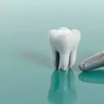 Trồng răng Implant mất bao lâu? Giải đáp chi tiết từ A đến Z cho người lần đầu cấy ghép