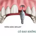 Trồng răng có đau không? Nỗi lo của rất nhiều người