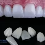 Dán Sứ Veneer – Kiến Tạo Nụ Cười Hoàn Hảo Không Cần Mài Răng