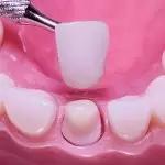 Khi Nào Nên Bọc Răng Sứ? Dấu Hiệu Và Lời Khuyên Từ Chuyên Gia