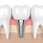 Trồng Răng Implant Tại Hà Nội: Giải Pháp Vàng Phục Hồi Răng Mất Vĩnh Viễn Và Ngăn Ngừa Tiêu Xương