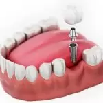 Quy Trình Cấy Ghép Implant Nha Khoa Tiêu Chuẩn Quốc Tế