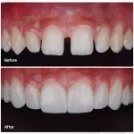 Hành Trình “Tái Sinh” Nụ Cười Và Sự Thay Đổi Vận Mệnh Tại Nha Khoa An Dental